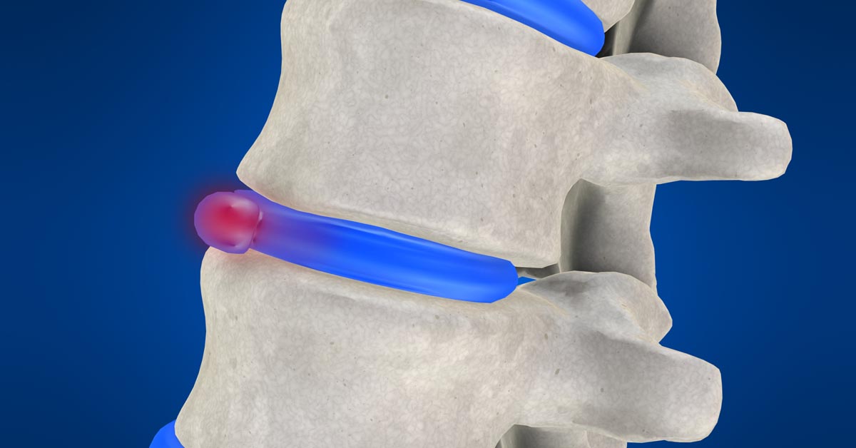 Spinal decompression therapy in Philadelphia