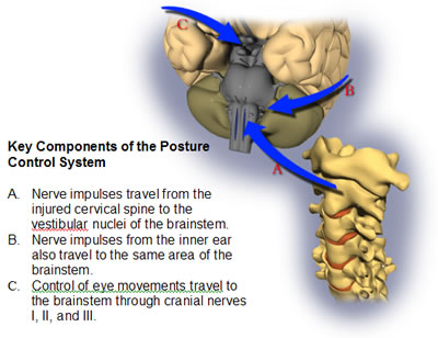 Brain injury and whiplash